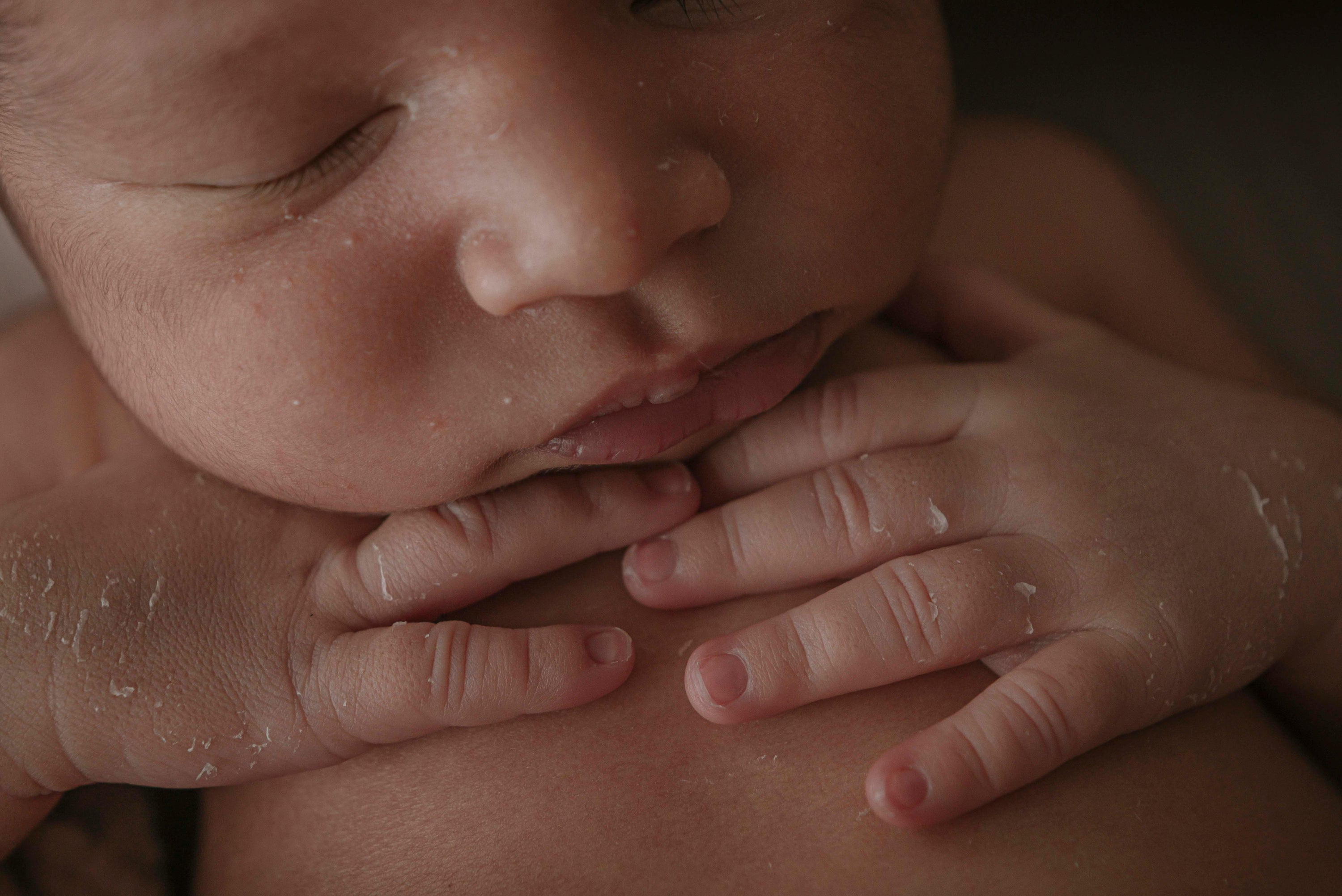 Crosta lattea nel neonato: cause, durata, rimedi delicati e quando preoccuparsi